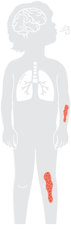 Infusion Reactions Diagram
